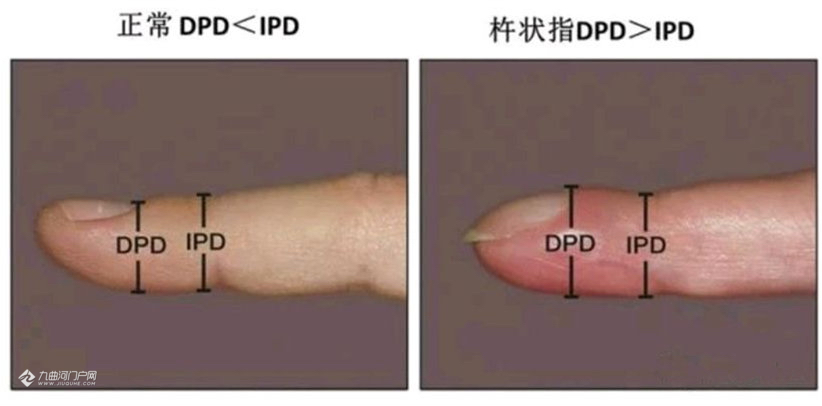 我没在意,已住icu" ,第一次听说杵状指 ,默默检查自己的手指… - 资阳